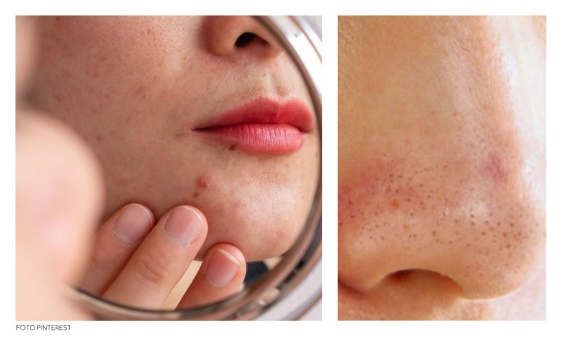 Skincare: como acabar com os cravos no nariz? Skincare: como acabar com os cravos no nariz?